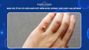 mụn cóc ở tay