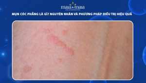 mụn cóc phẳng