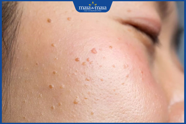 mụn cóc phẳng lây lan