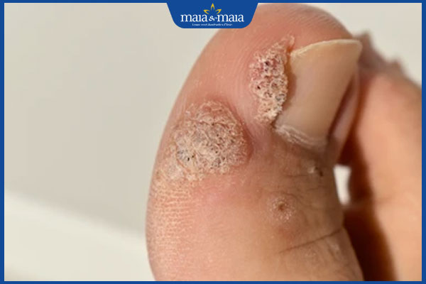 Các loại mụn cóc thường gặp và cách điều trị hiệu quả 3 mụn cóc quanh móng