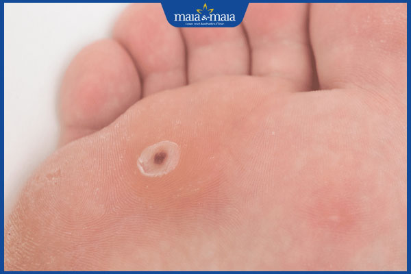 Mụn cóc có tự hết không? Nên loại bỏ mụn như nào cho đúng? 2 mụn cóc sắp khỏi