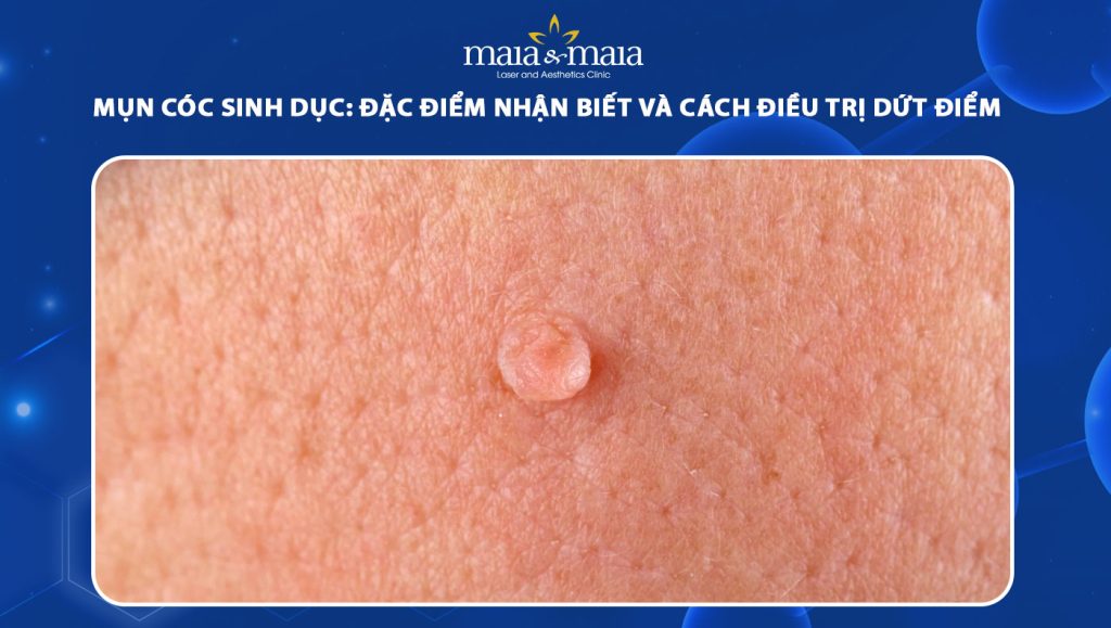 Mụn cóc sinh dục: Đặc điểm nhận biết, cách điều trị dứt điểm 1 mụn cóc sinh dục