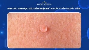 mụn cóc sinh dục