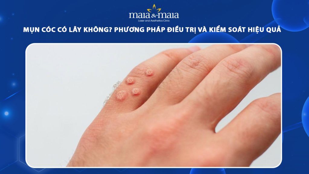 mụn cóc có lây không