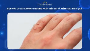 mụn cóc có lây không