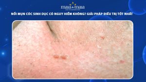 mụn cóc sinh dục có nguy hiểm không