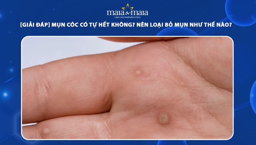 Mụn cóc có tự hết không? Nên loại bỏ mụn như nào cho đúng? 1 mụn cóc sinh dục có tự hết không