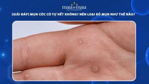 mụn cóc sinh dục có tự hết không