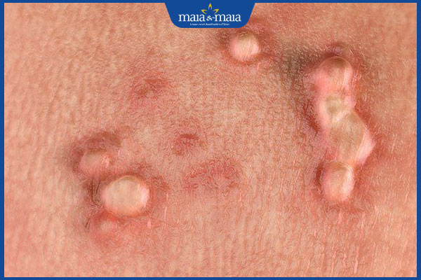 mụn cóc sinh dục lây