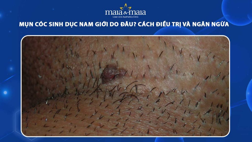 Mụn cóc sinh dục nam giới do đâu? Cách điều trị và ngăn ngừa 1 mụn cóc sinh dục nam giới