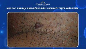 mụn cóc sinh dục nam giới