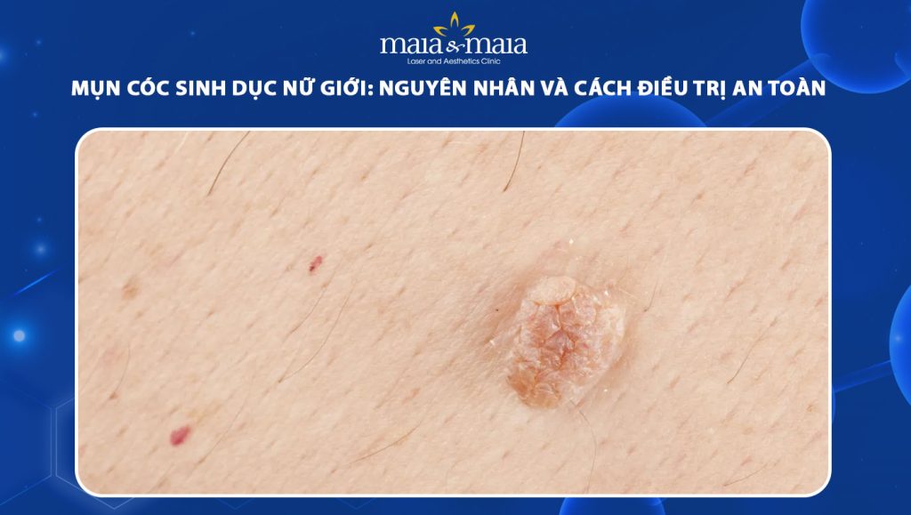 mụn cóc sinh dục nữ giới