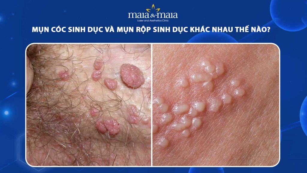 Mụn cóc sinh dục và mụn rộp sinh dục khác nhau thế nào? 1 mụn cóc sinh dục và mụn rộp sinh dục