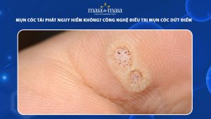 mụn cóc tái phát