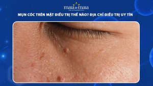 mụn cóc trên mặt