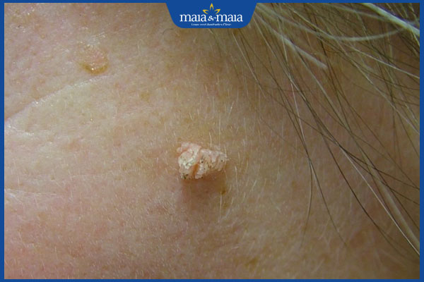 mụn cóc trên mặt gây mất thẩm mỹ