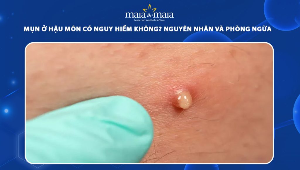 Mụn ở hậu môn nguy hiểm không? Nguyên nhân & cách phòng ngừa 1 mụn ở hậu môn