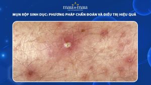 mụn rộp sinh dục