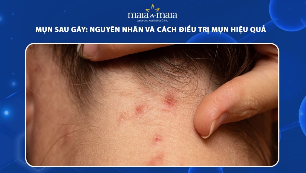 Mụn sau gáy: Nguyên nhân và cách điều trị mụn hiệu quả 1 mụn sau gáy