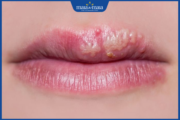 mụn trắng ở môi