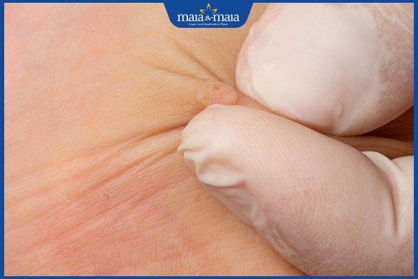 người bị mụn cóc phẳng