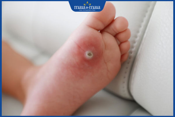 nguy hiểm khi nổi mụn cóc ở trẻ em