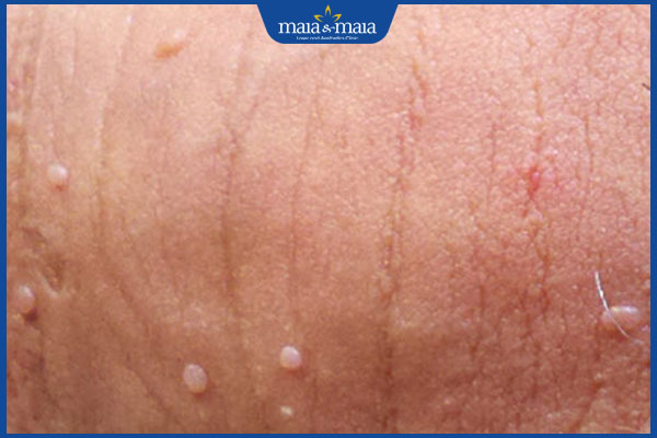 nhận biết mụn cóc hậu môn