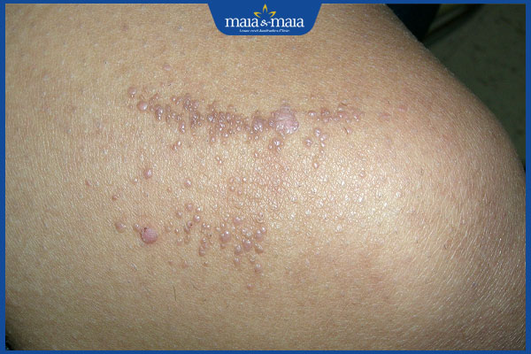 nhận biết mụn cóc phẳng