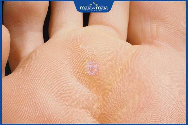 nhận biết mụn cóc sắp khỏi