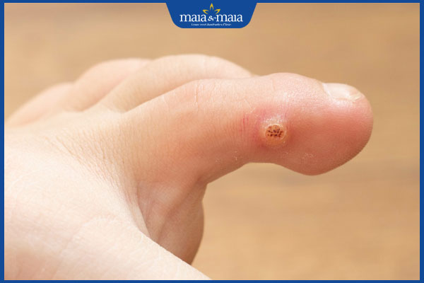 Các loại mụn cóc thường gặp và cách điều trị hiệu quả 2 nổi mụn cóc ở chân