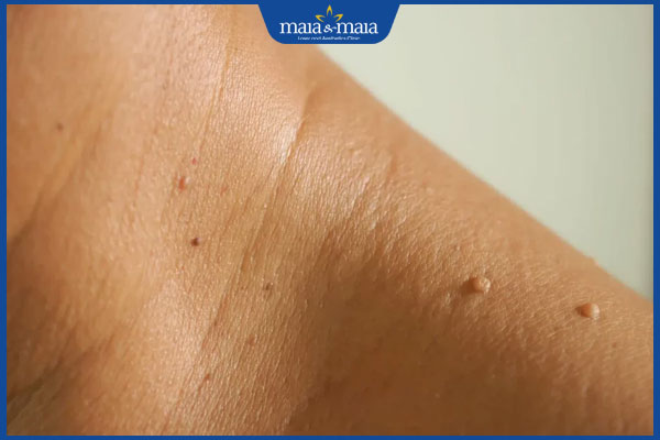 Mụn cóc ở cổ: Nguyên nhân và cách điều trị hiệu quả 2 nổi mụn cóc ở cổ