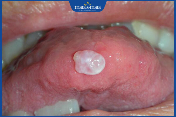 nổi mụn cóc ở lưỡi