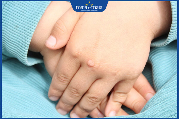 nổi mụn cóc ở trẻ em