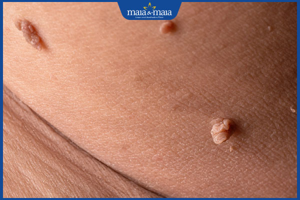 nổi mụn cóc sinh dục ở nữ