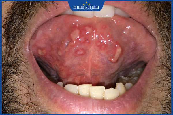 Cuống lưỡi nổi mụn đỏ: Nguyên nhân và cách điều trị hiệu quả 2 nổi mụn đỏ ở cuống lưỡi