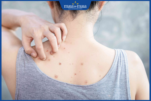 Mụn nang ở lưng do đâu? Gợi ý biện pháp cải thiện hiệu quả 2 nổi mụn đỏ ở lưng
