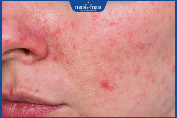 nổi mụn đỏ quanh mặt