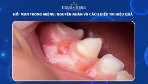 nổi mụn trong miệng