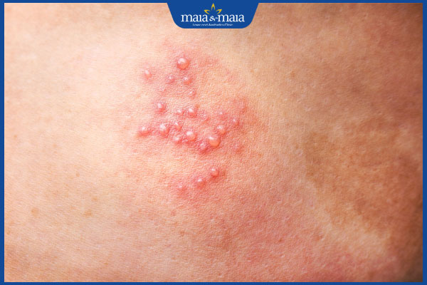 nốt mụn rộp sinh dục