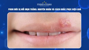 phun môi bị nổi mụn trắng