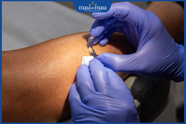 sinh thiết mụn cóc