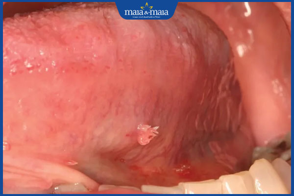 Nổi mụn ở lưỡi là dấu hiệu bệnh gì? Nguyên nhân và cách phòng ngừa 3 sùi mào gà ở lưỡi