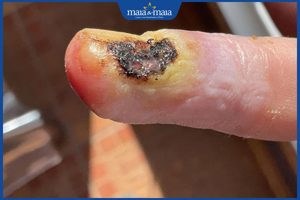 tác hại khi đốt mụn cóc bằng nhang