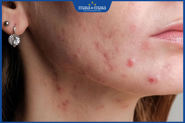 tình trạng mụn nhẹ