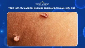 trị mụn cóc sinh dục