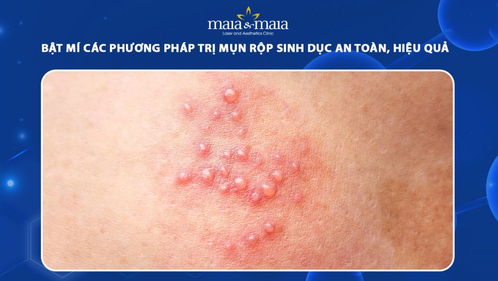 Bật mí 7 phương pháp trị mụn rộp sinh dục an toàn, hiệu quả 1 trị mụn rộp sinh dục
