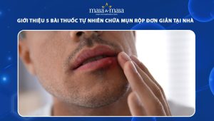 bài thuốc tự nhiên chữa mụn rộp