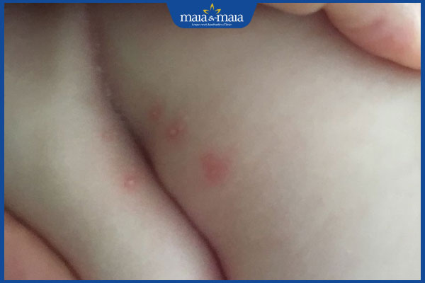 Bé trai bị nổi mụn ở bộ phận sinh dục phải làm sao? 2 bé trai nổi mụn ở vùng kín