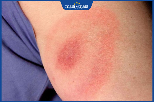 Nổi vòng tròn đỏ trên da là bị sao? Điều trị và phòng ngừa 3 bệnh lyme