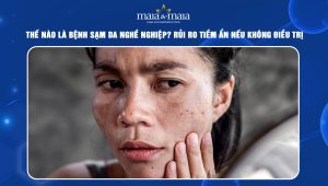 Bệnh sạm da nghề nghiệp